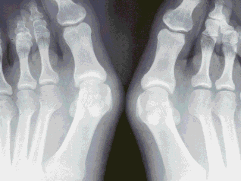 Bunions, Hammertoes, and More: When Is It Time to See a Foot & Ankle Specialist?
