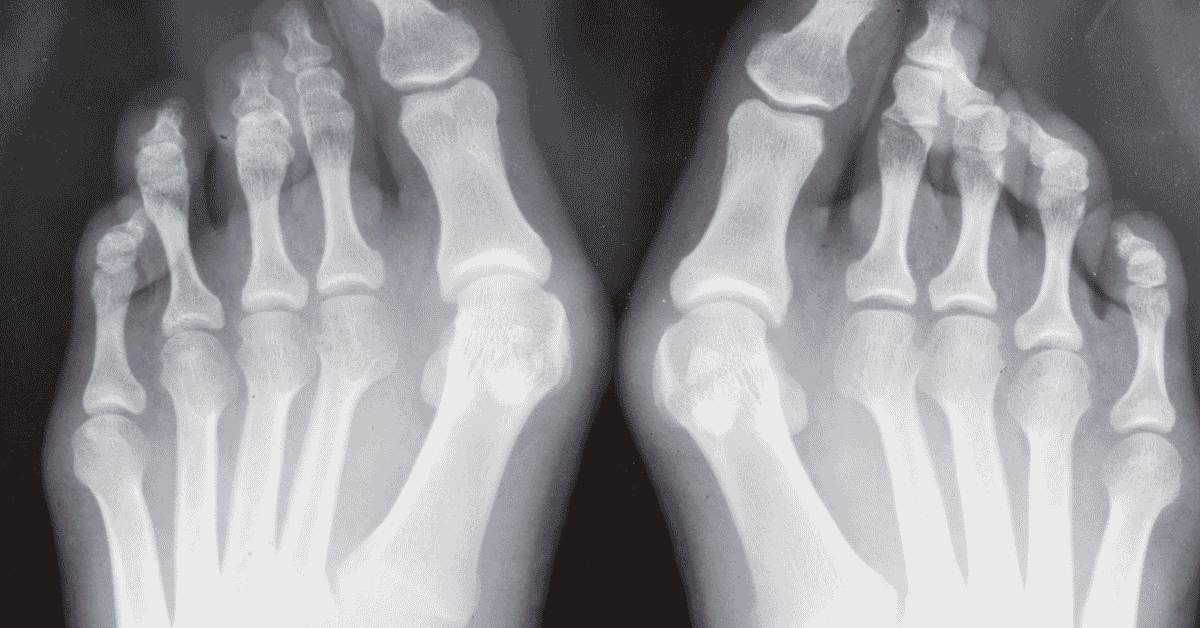 Bunions, Hammertoes, and More: When Is It Time to See a Foot & Ankle Specialist?