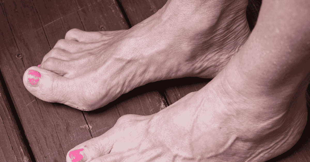 Bunions: Why They Get Worse Over Time (And When Surgery Makes Sense) Bunions: Why They Get Worse Over Time (And When Surgery Makes Sense)