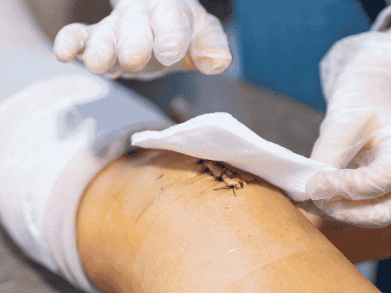 Wound Care 101: Why Some Foot Wounds Don’t Heal on Their Own